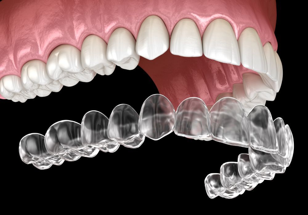矯正治療で歯が動く仕組みを解説